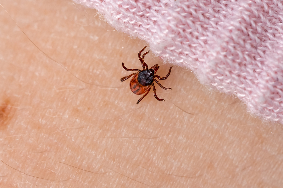 Infected tick on human skin. Carrier of infections of encephalitis disease and Lyme borreliosis. Parasite mite on person crawling under clothes. Ixodes ricinus. Dangerous biting insect